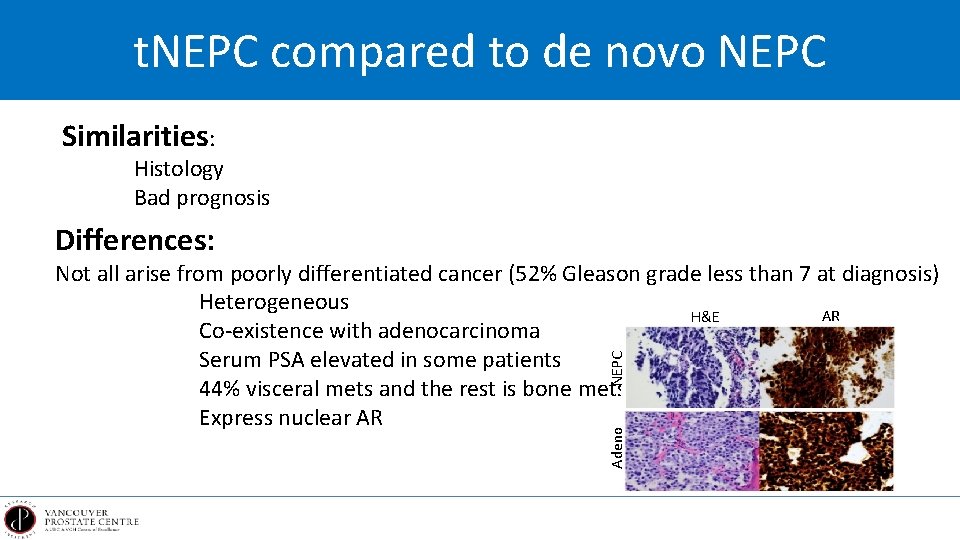 t. NEPC compared to de novo NEPC Similarities: Histology Bad prognosis Differences: Adeno NEPC