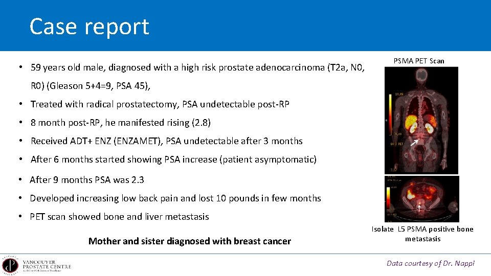 Case report • 59 years old male, diagnosed with a high risk prostate adenocarcinoma