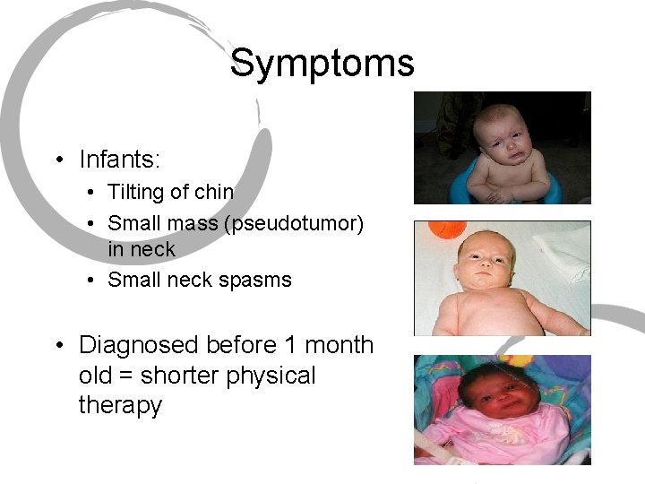 Symptoms • Infants: • Tilting of chin • Small mass (pseudotumor) in neck •