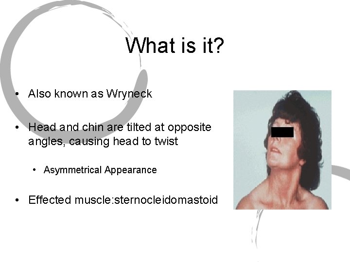 What is it? • Also known as Wryneck • Head and chin are tilted