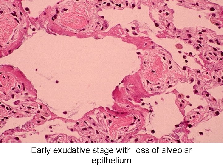 Early exudative stage with loss of alveolar epithelium 