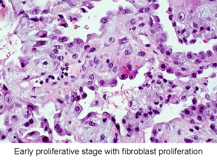 Early proliferative stage with fibroblast proliferation 