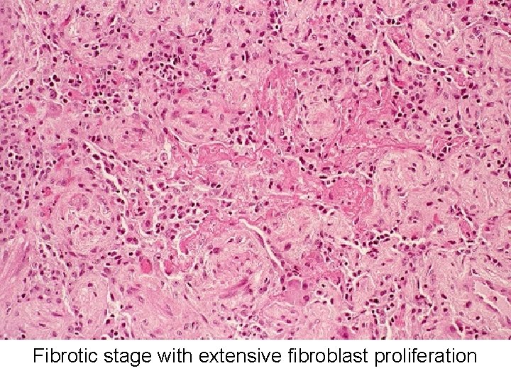 Fibrotic stage with extensive fibroblast proliferation 