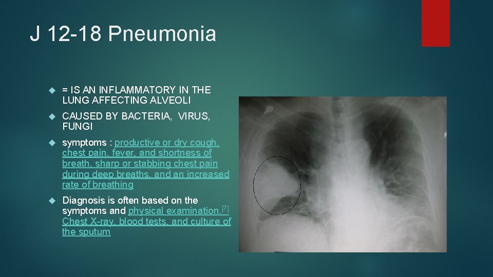 J 12 -18 Pneumonia = IS AN INFLAMMATORY IN THE LUNG AFFECTING ALVEOLI CAUSED