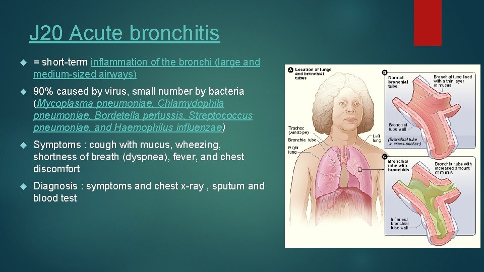 J 20 Acute bronchitis = short-term inflammation of the bronchi (large and medium-sized airways)