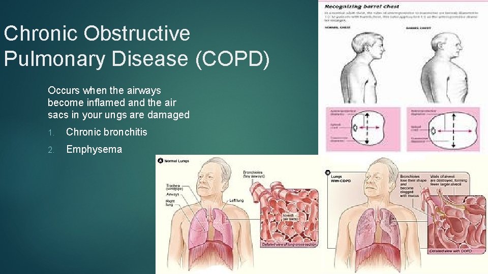 Chronic Obstructive Pulmonary Disease (COPD) Occurs when the airways become inflamed and the air