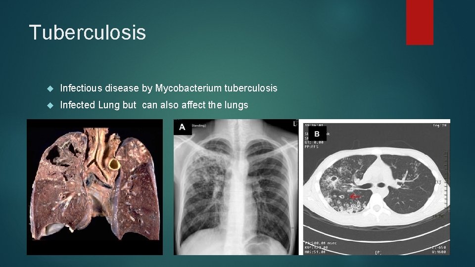 Tuberculosis Infectious disease by Mycobacterium tuberculosis Infected Lung but can also affect the lungs