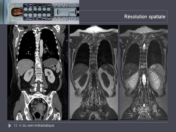 Résolution spatiale 12 K du sein métastatique 