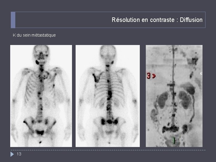 Résolution en contraste : Diffusion K du sein métastatique 13 