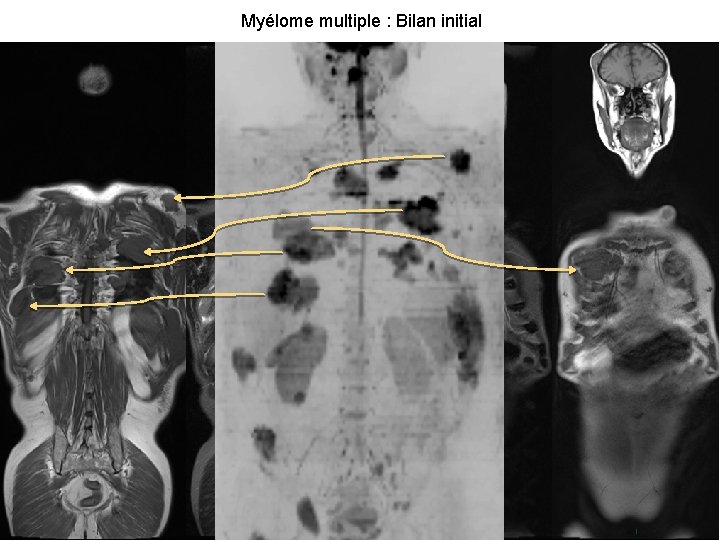 Myélome multiple : Bilan initial 15 