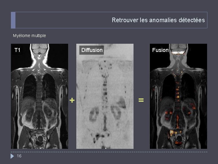 Retrouver les anomalies détectées Myélome multiple T 1 Diffusion + 16 Fusion = 