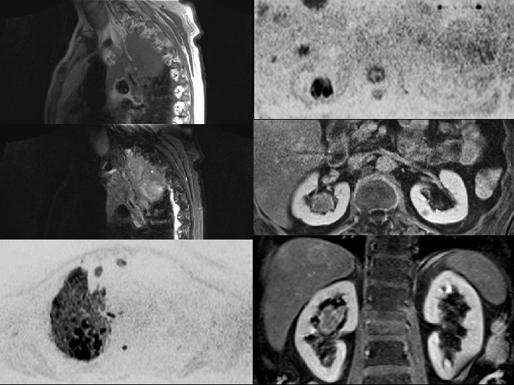 Bilan d’extension d’un K bronchique 18 
