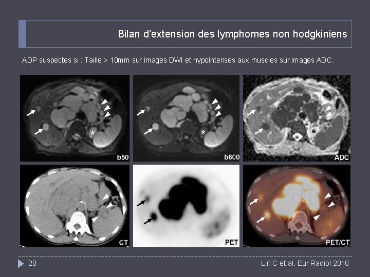 Bilan d’extension des lymphomes non hodgkiniens ADP suspectes si : Taille > 10 mm
