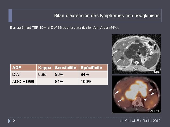 Bilan d’extension des lymphomes non hodgkiniens Bon agrément TEP-TDM et DWIBS pour la classification