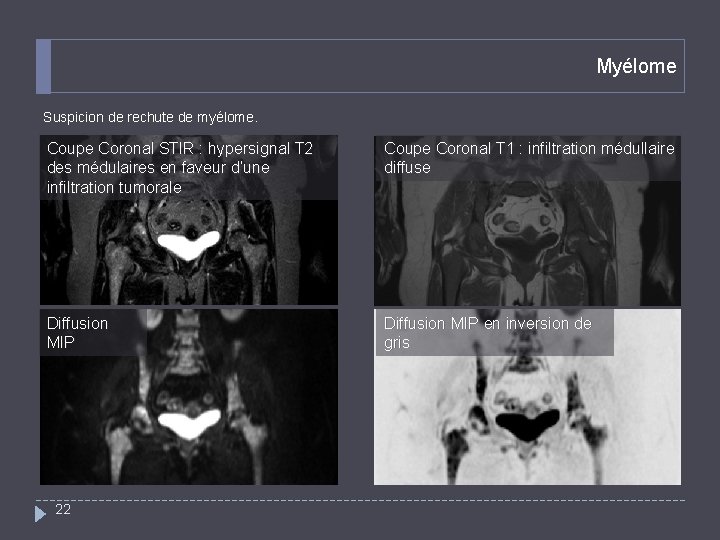 Myélome Suspicion de rechute de myélome. Coupe Coronal STIR : hypersignal T 2 des