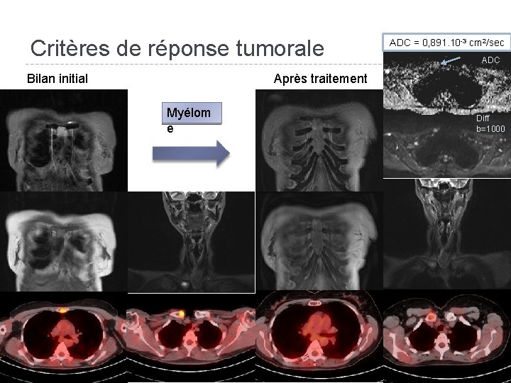 Critères de réponse tumorale Bilan initial ADC Après traitement Myélom e 25 ADC =