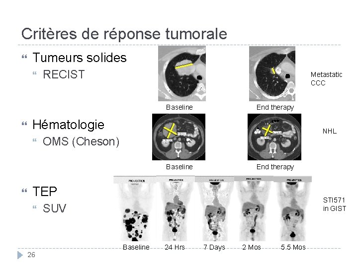 Critères de réponse tumorale Tumeurs solides RECIST Metastatic CCC Baseline End therapy Hématologie NHL