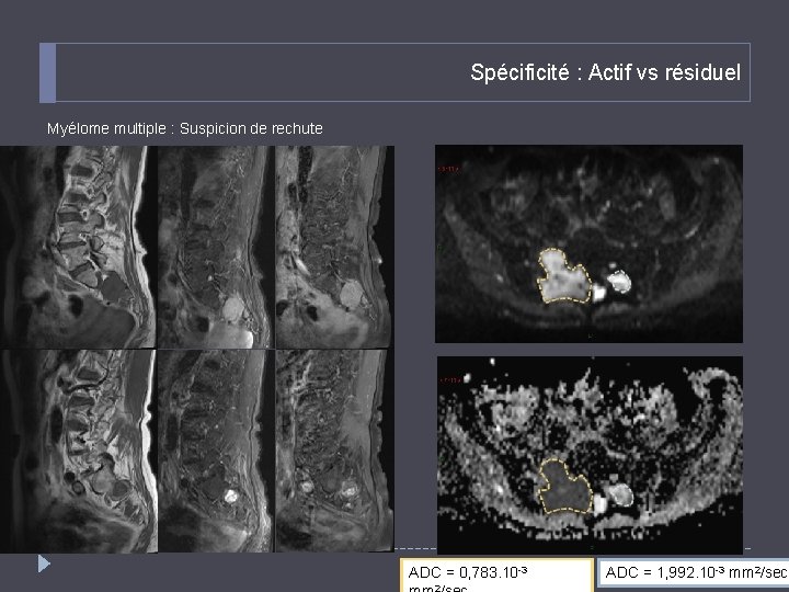 Spécificité : Actif vs résiduel Myélome multiple : Suspicion de rechute 27 ADC =