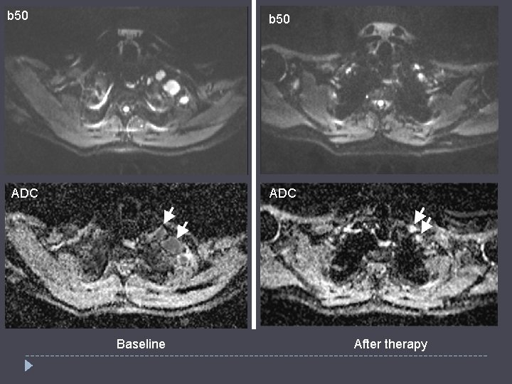 b 50 ADC Baseline After therapy 