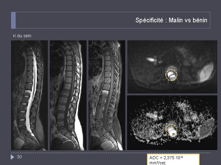 Spécificité : Malin vs bénin K du sein 30 ADC = 2, 375. 10