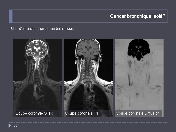 Cancer bronchique isolé? Bilan d’extension d’un cancer bronchique. Coupe coronale STIR 33 Coupe coronale