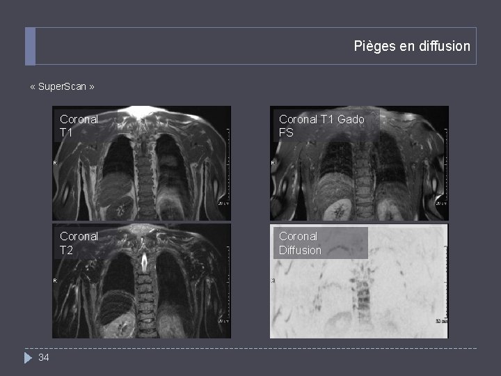 Pièges en diffusion « Super. Scan » 34 Coronal T 1 Gado FS Coronal