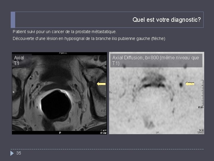 Quel est votre diagnostic? Patient suivi pour un cancer de la prostate métastatique. Découverte