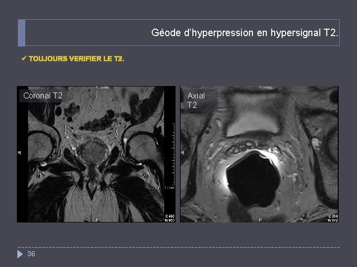 Géode d’hyperpression en hypersignal T 2. Coronal T 2 36 Axial T 2 