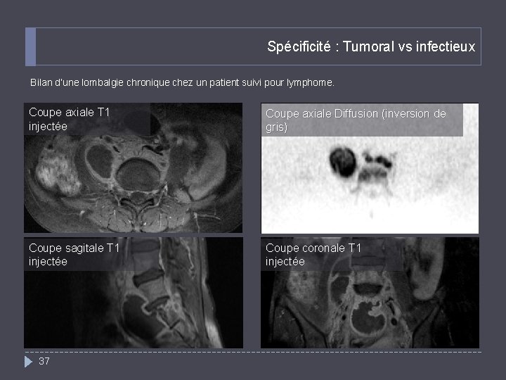 Spécificité : Tumoral vs infectieux Bilan d’une lombalgie chronique chez un patient suivi pour