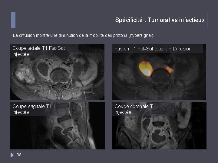 Spécificité : Tumoral vs infectieux La diffusion montre une diminution de la mobilité des