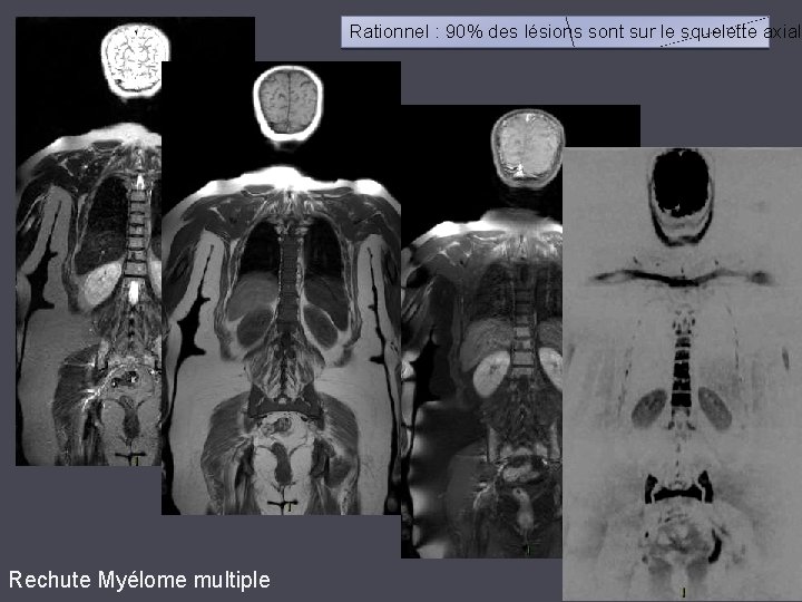 Rationnel : 90% des lésions sont sur le squelette axial Rechute Myélome multiple 