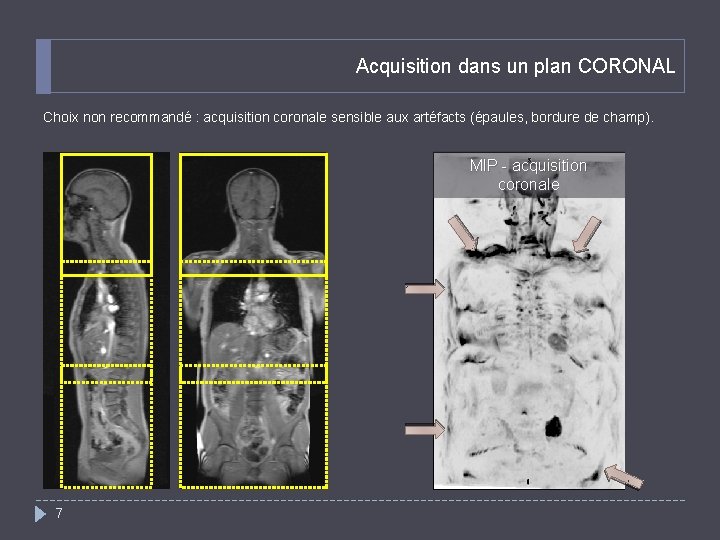 Acquisition dans un plan CORONAL Choix non recommandé : acquisition coronale sensible aux artéfacts
