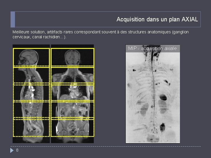 Acquisition dans un plan AXIAL Meilleure solution, artéfacts rares correspondant souvent à des structures
