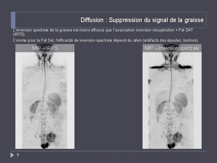 Diffusion : Suppression du signal de la graisse L’inversion spectrale de la graisse est