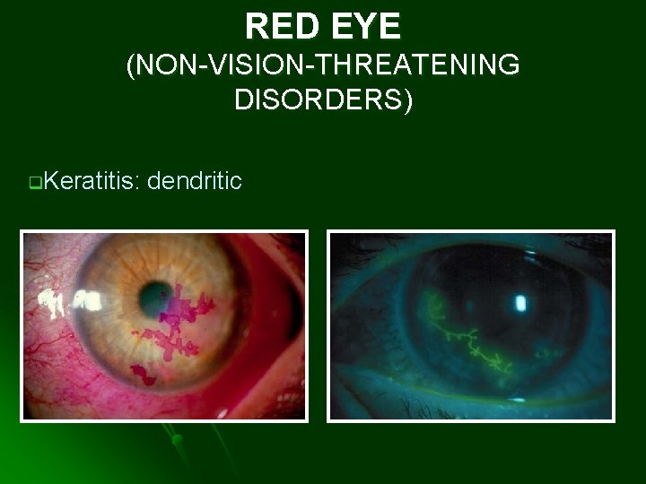 RED EYE (NON-VISION-THREATENING DISORDERS) q. Keratitis: dendritic 