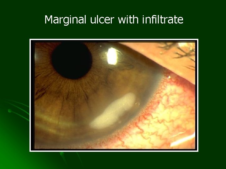 Marginal ulcer with infiltrate 