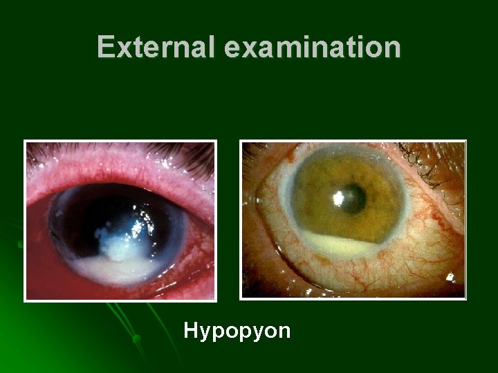 External examination Hypopyon 