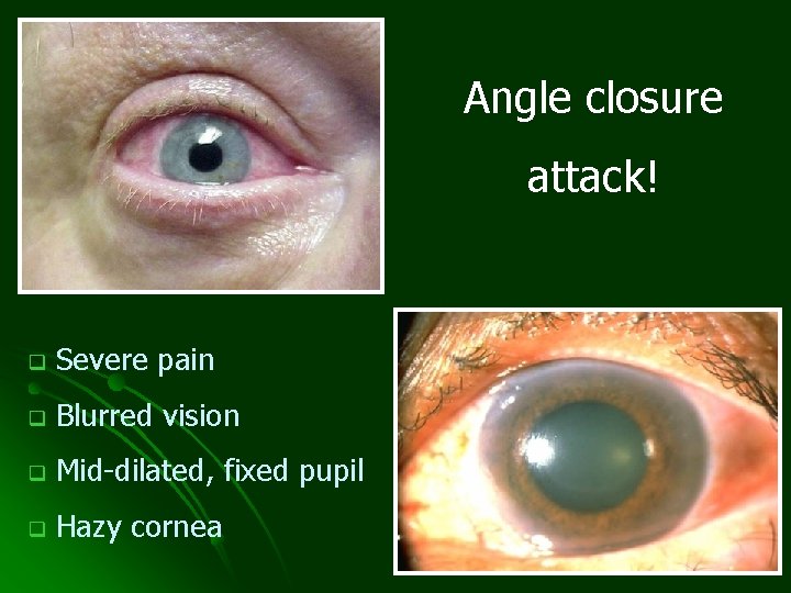 Angle closure attack! q Severe pain q Blurred vision q Mid-dilated, fixed pupil q