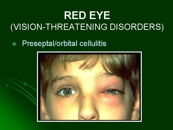 RED EYE (VISION-THREATENING DISORDERS) v Preseptal/orbital cellulitis 