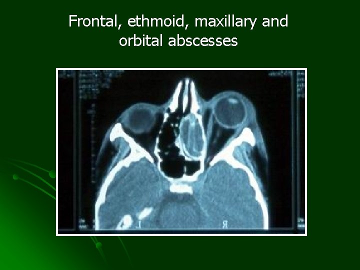 Frontal, ethmoid, maxillary and orbital abscesses 