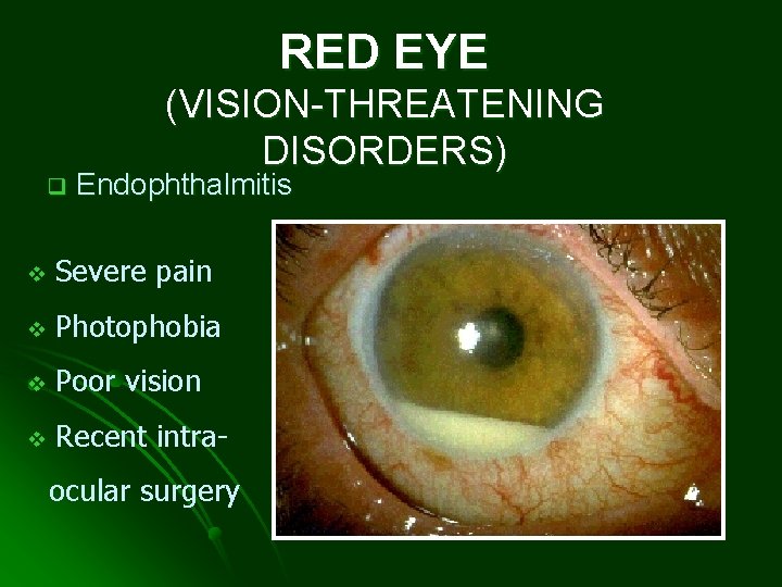 RED EYE q (VISION-THREATENING DISORDERS) Endophthalmitis v Severe pain v Photophobia v Poor vision