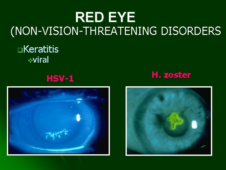 RED EYE (NON-VISION-THREATENING DISORDERS q. Keratitis vviral HSV-1 H. zoster 