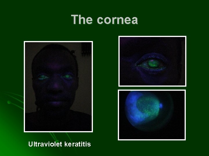 The cornea Ultraviolet keratitis 