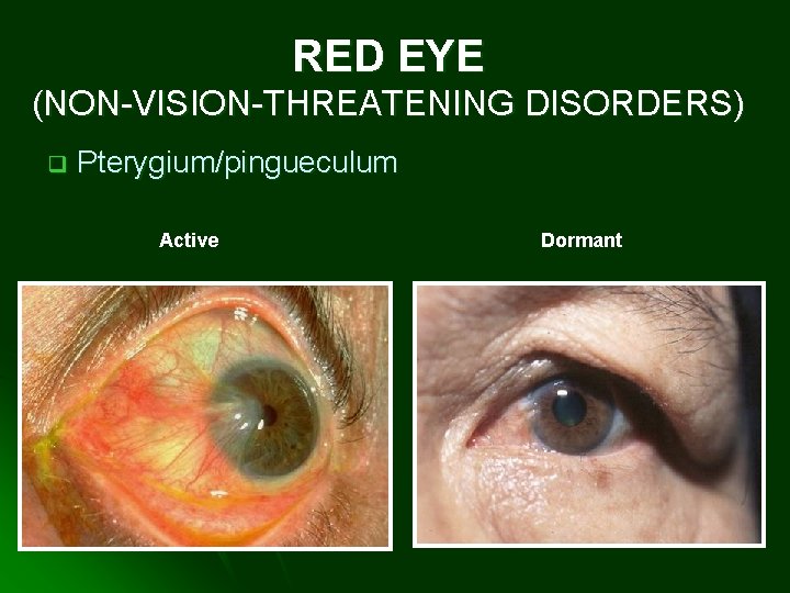RED EYE (NON-VISION-THREATENING DISORDERS) q Pterygium/pingueculum Active Dormant 