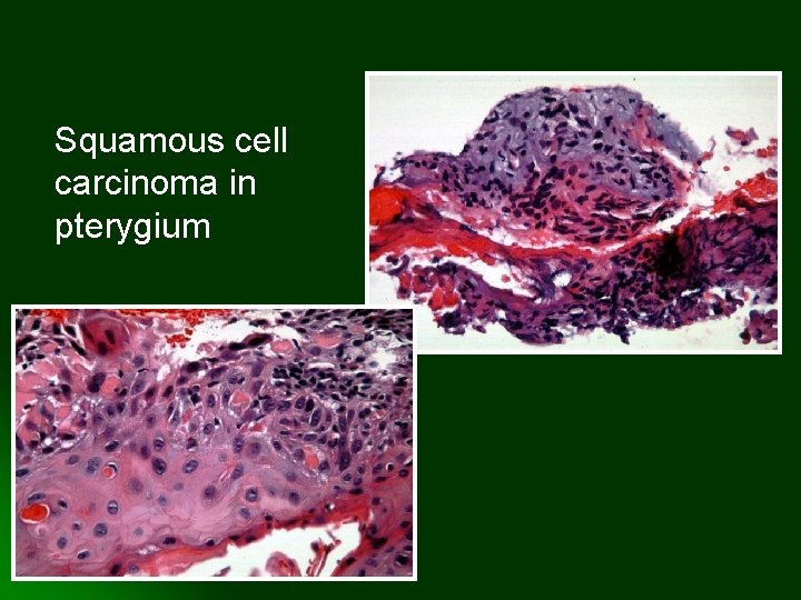 Squamous cell carcinoma in pterygium 