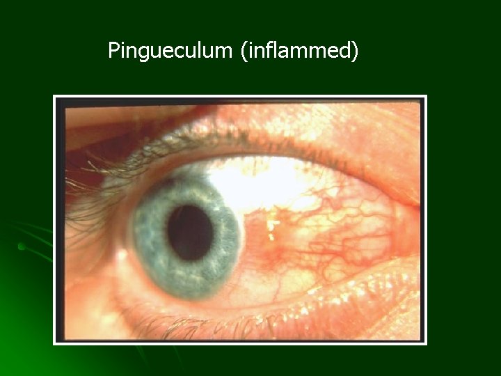 Pingueculum (inflammed) 
