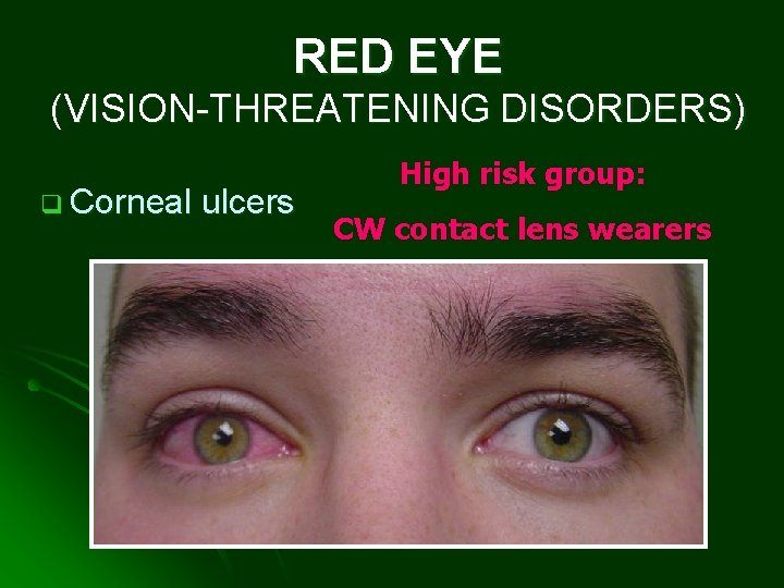 RED EYE (VISION-THREATENING DISORDERS) q Corneal ulcers High risk group: CW contact lens wearers