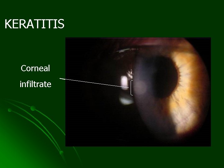 KERATITIS Corneal infiltrate 