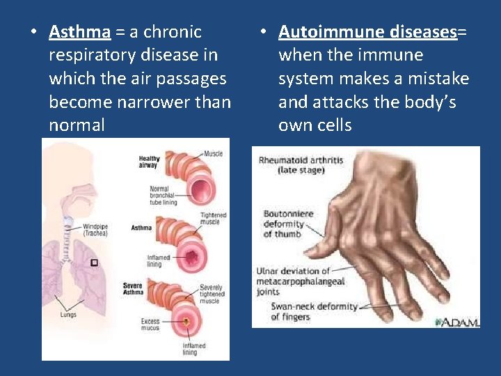  • Asthma = a chronic respiratory disease in which the air passages become