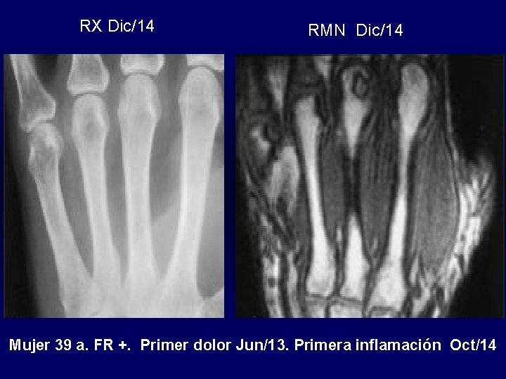 RX Dic/14 RMN Dic/14 Mujer 39 a. FR +. Primer dolor Jun/13. Primera inflamación